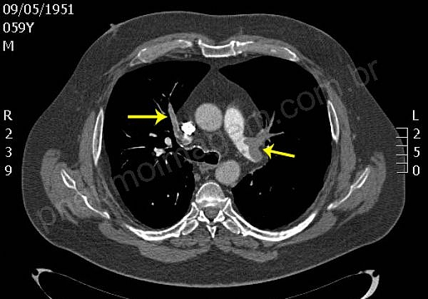DESTAQUES DO CHEST 2015: ATUALIZA��O EM NOVOS ANTICOAGULANTES ORAIS